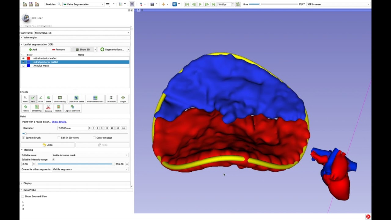 Mitral Valve Analysis: 3DSlicer