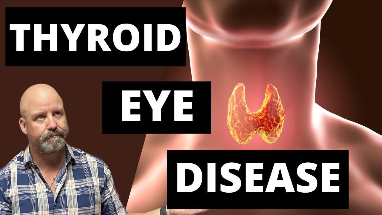 Thyroid Eye Disease: Symptoms, Treatments, and How to Fix Dry Eye Issues