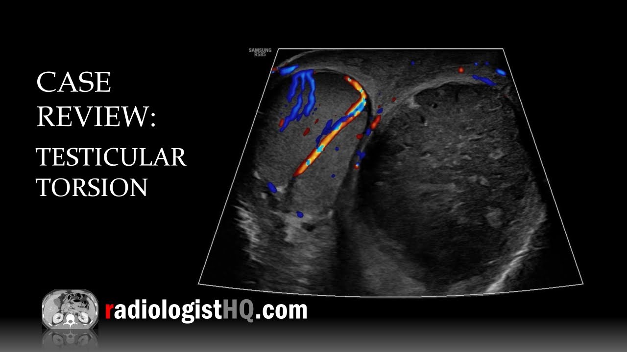 Case Review: Ultrasound of Testicular Torsion