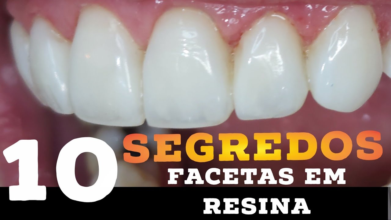 🛑10 GRANDES SEGREDOS PARA TRANSFORMAR SUAS FACETAS EM RESINA!🔥🤩
