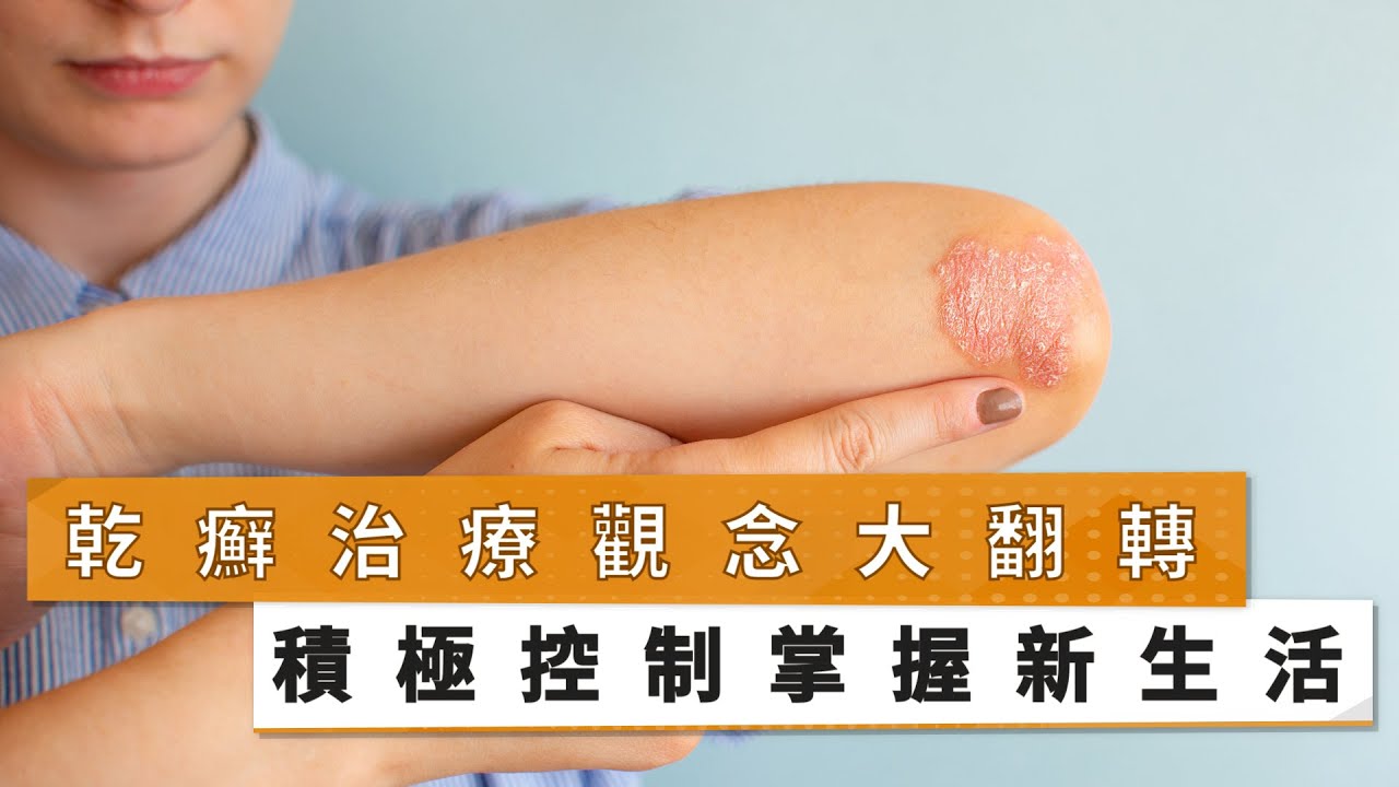 【鐘文宏醫師】乾癬治療觀念大翻轉　積極控制掌握新生活｜健康醫療網