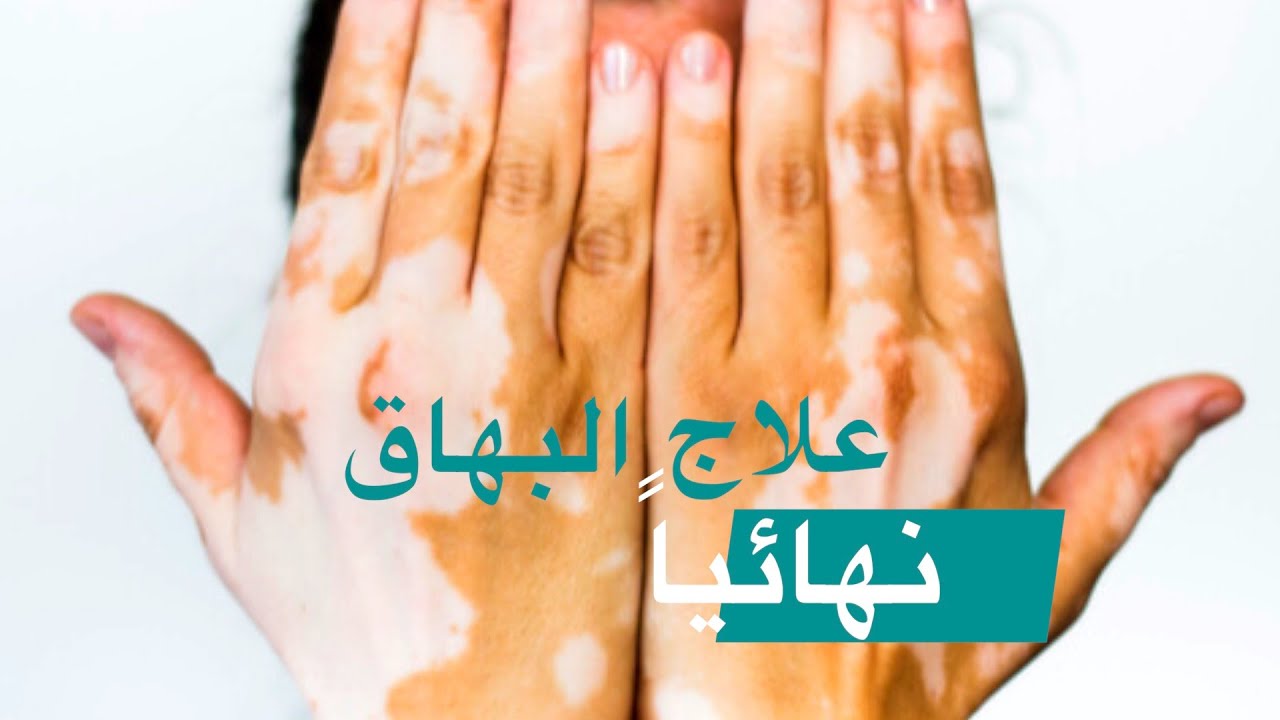 مرض البهاق ( هتخف يعني هتخف )