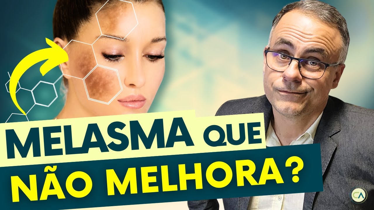 MELASMA: 4 DICAS PODEROSAS para CLAREAR sua PELE!