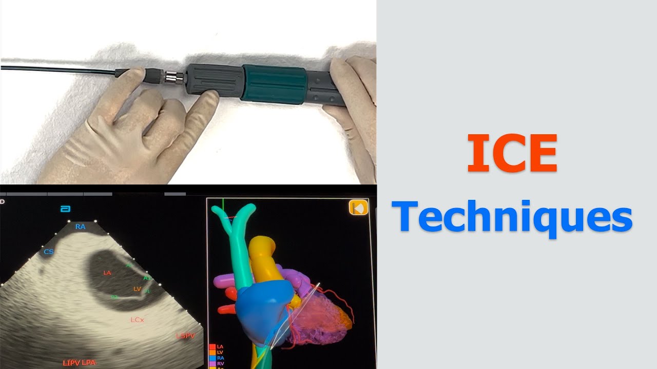 [SUB]Manipulation & Basic Views of Intracardiac Echocardiography