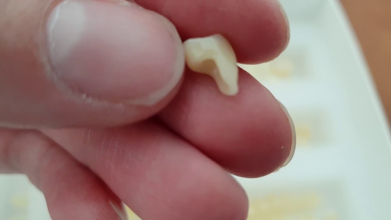 Denticor - predstavenie zubných náhrad časť 1.