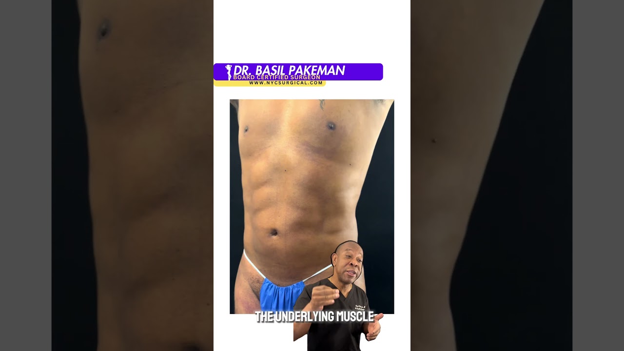 High Definition Male Liposuction