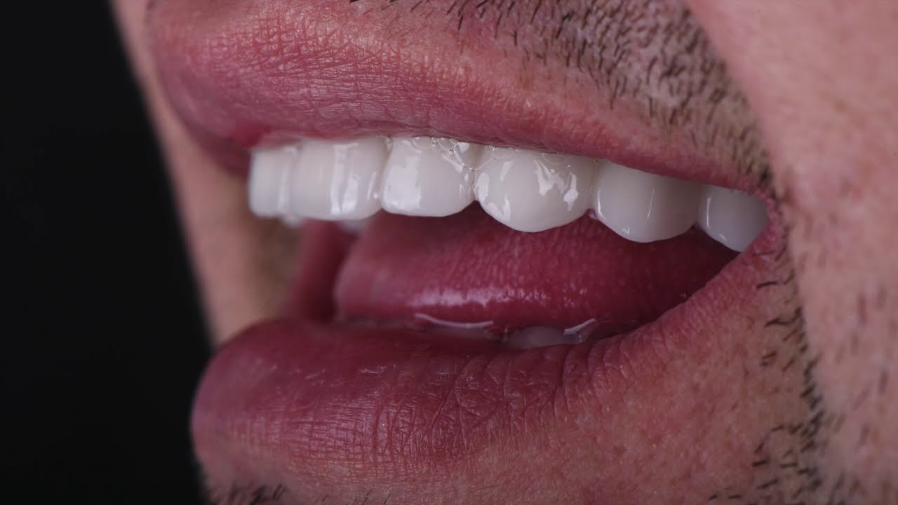 Sinus lift i ugradnja implantata