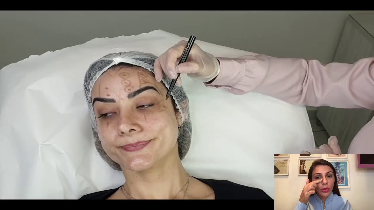 BOTOX com HYALURON PEN