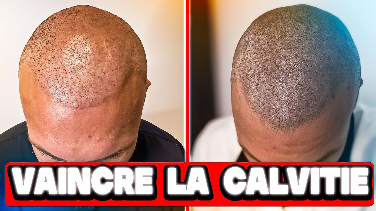 LA TRICOPIGMENTATION LA NOUVELLE TECHNIQUE POUR COMBATTRE LA CALVITIE !