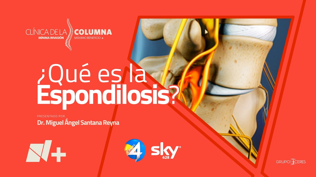 &iquest;Qu&eacute; es la Espondilosis? - Cl&iacute;nica de la Columna