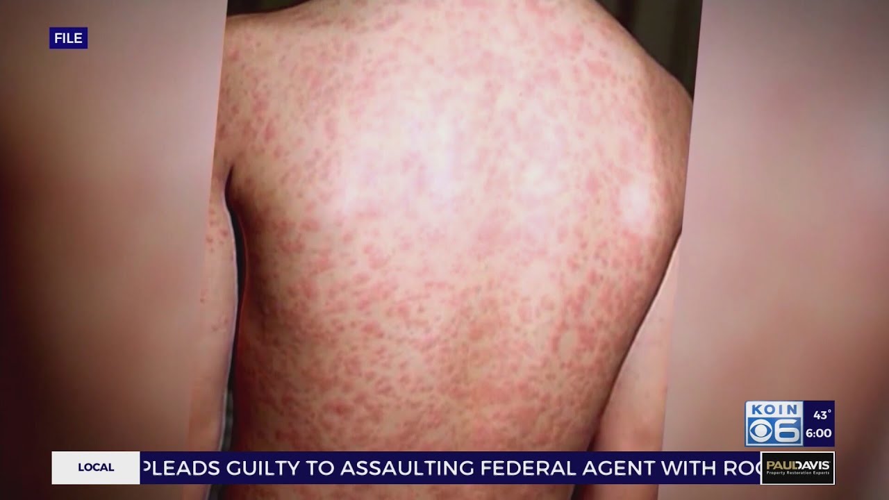 Measles infections in Oregon grow to 'outbreak' status