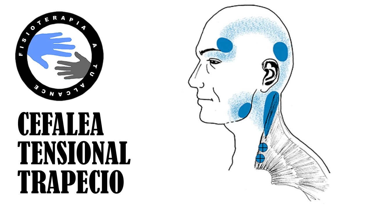 Dolor de cabeza, masaje del musculo trapecio superior para la cefalea tensional