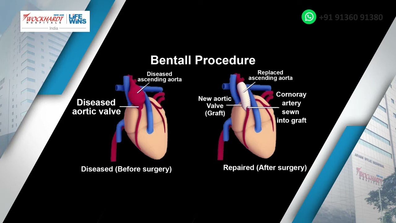 Aortic Root Replacement with Tissue prosthesis ( Bio-Bentall )
