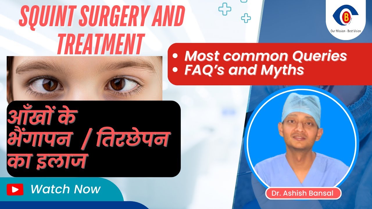 Squint Surgery/ भेंगापन/ तिरछेपन / Strabismus : Myths, FAQs & Best Treatment Options | Crossed Eyes