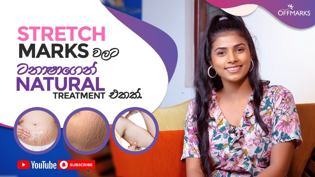 Stretch marks වලට ටනාෂාගෙන් Natural Treatment එකක්.