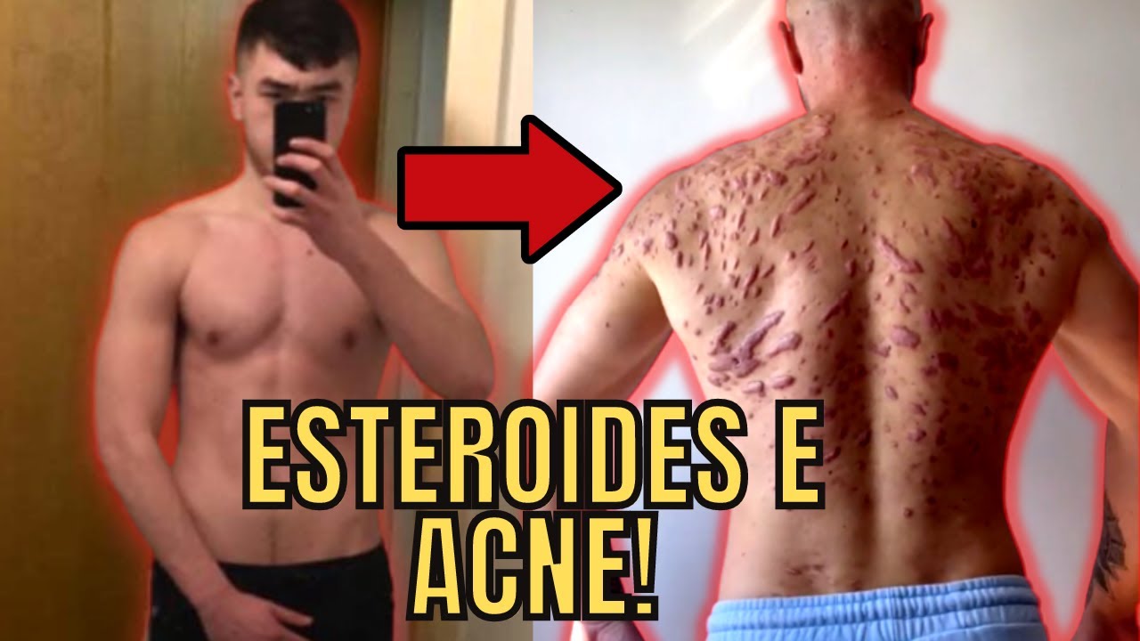 Esteroides deixaram a pele dele assim!