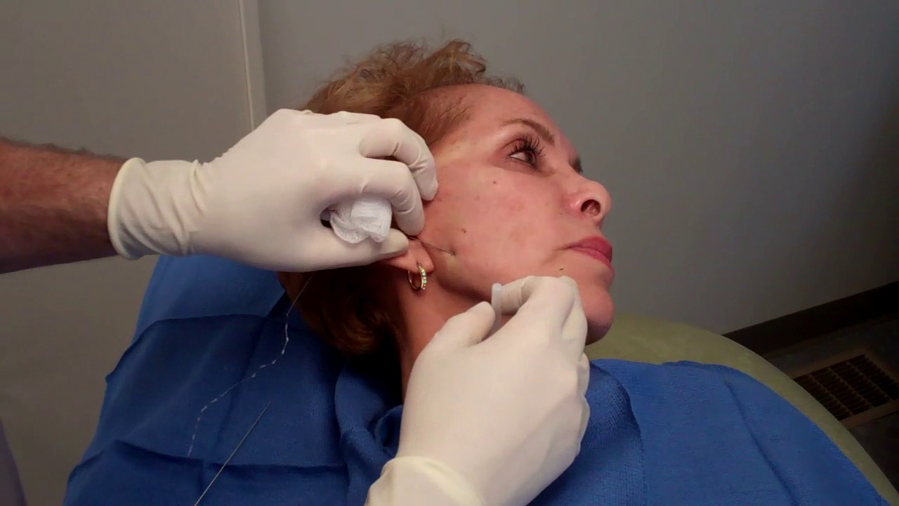 Silhouette InstaLift Threads with Dr  Janowski