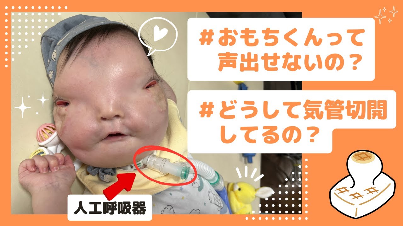 おもちくんの声が出ない理由。気管切開について【1歳4ヶ月/医療的ケア児】