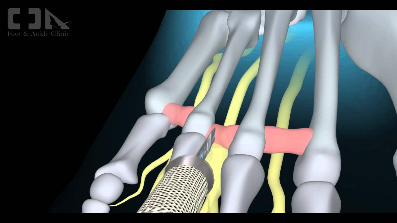 Minimally Invasive Morton's Neuroma Surgery