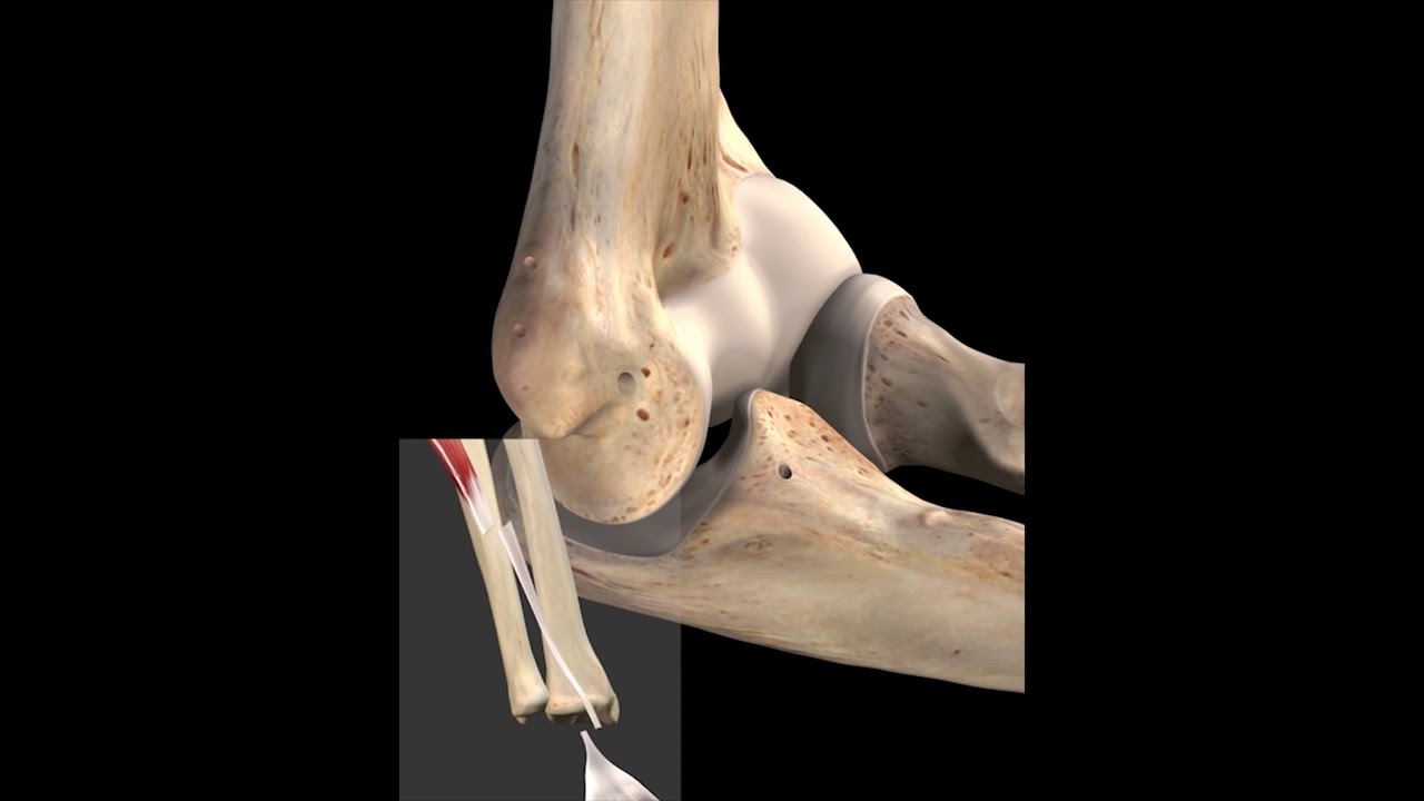 Ulnar Collateral Ligament Repair - 3D Medical Animation