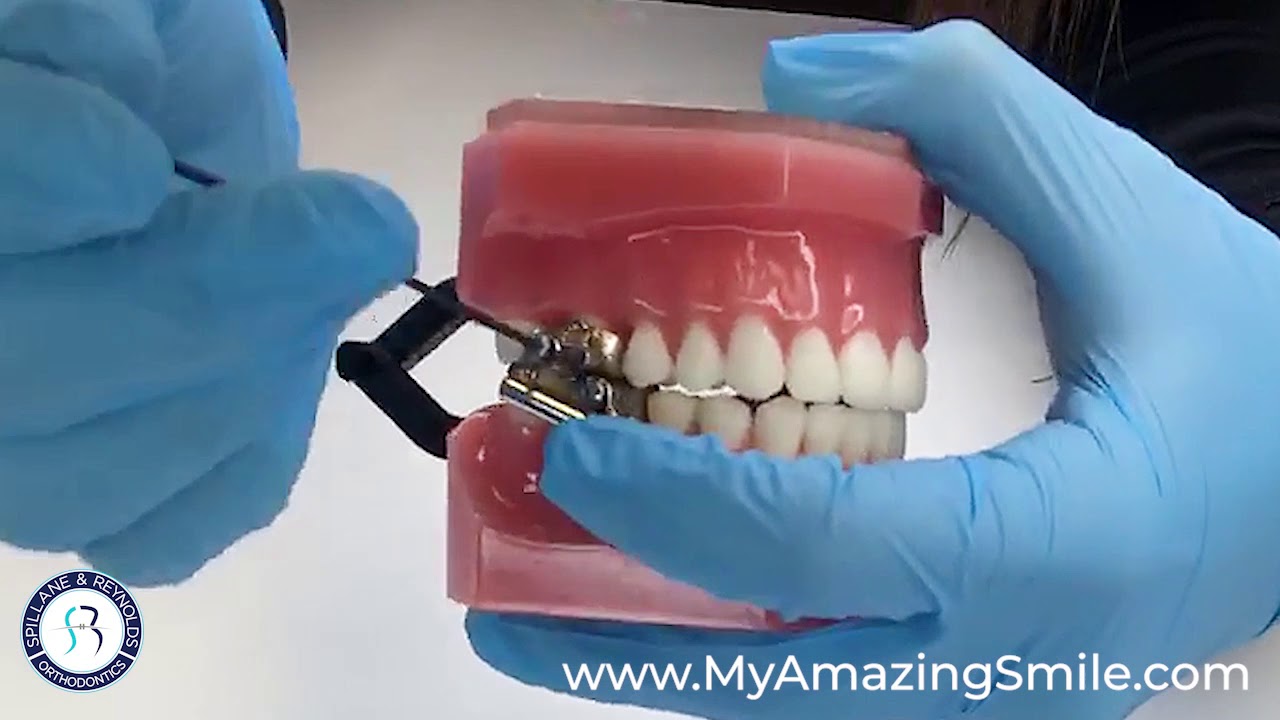 Repair a Herbst Appliance At Home - Spillane & Reynolds Orthodontics Tips & Tricks