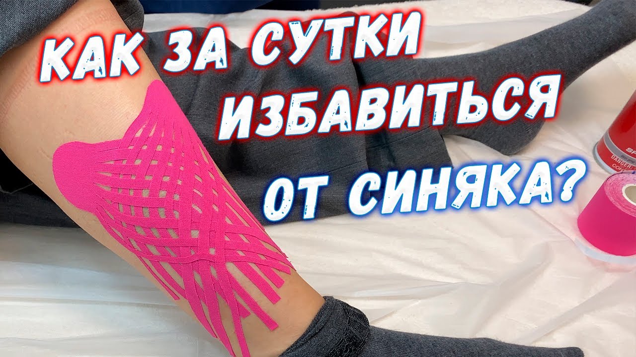 Как за сутки избавиться от синяка на ноге? Секретная олимпийская методика!
