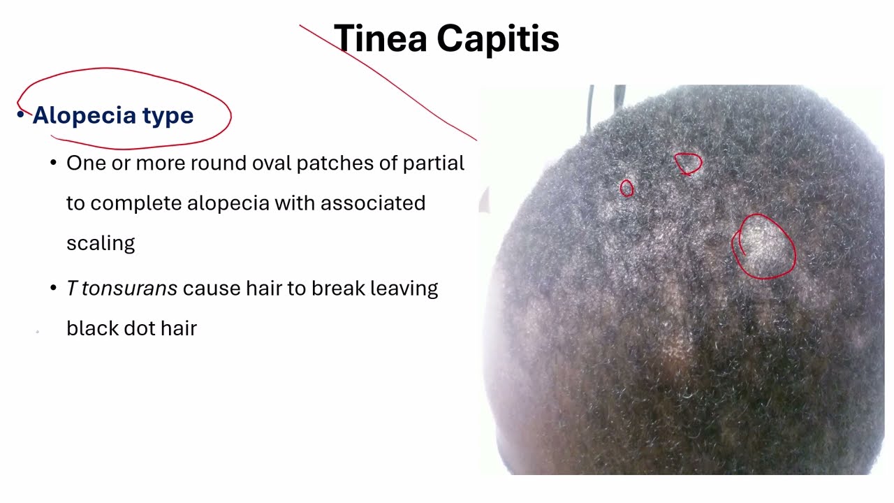 Tinea Capitis Tips and Tricks
