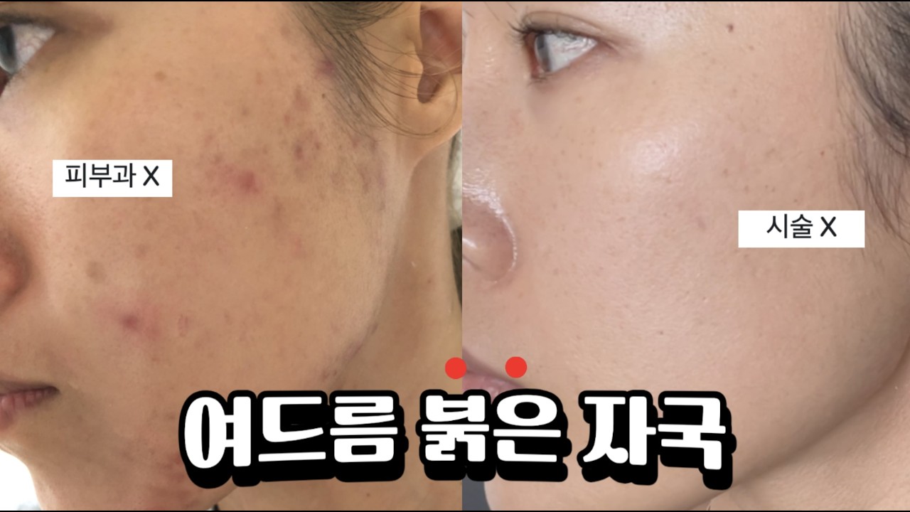 [구독자 요청🔥] 여드름 붉은 자국 고민? 👉 이 영상 하나면 ✅ 싹 해결! (광고 없음)