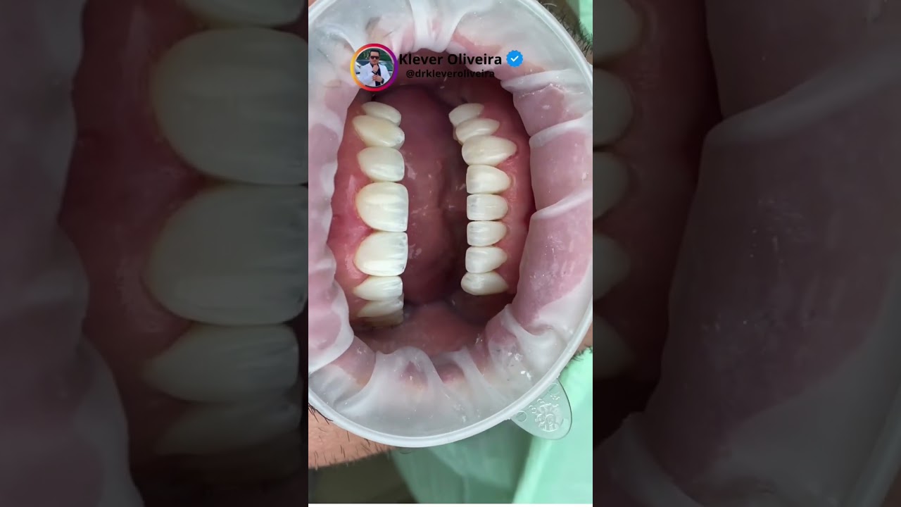 Caso complexo mas totalmente poss&iacute;vel, paciente ser&aacute; finalizado com implantes 💪🏻🚀