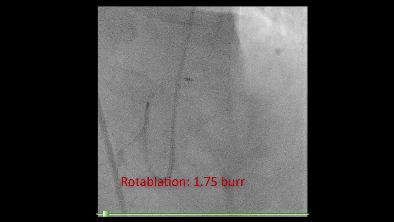 Left main PCI, Calcified aorto-ostial lesion