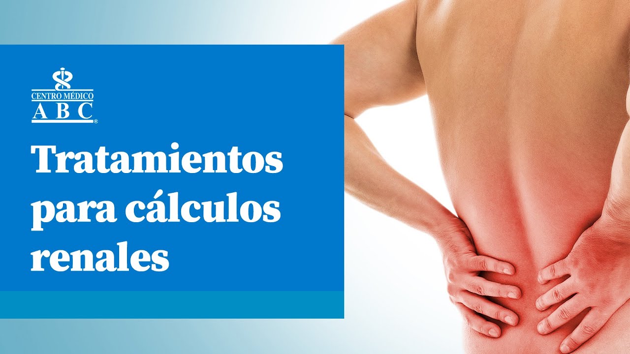 Tratamientos para c&aacute;lculos renales