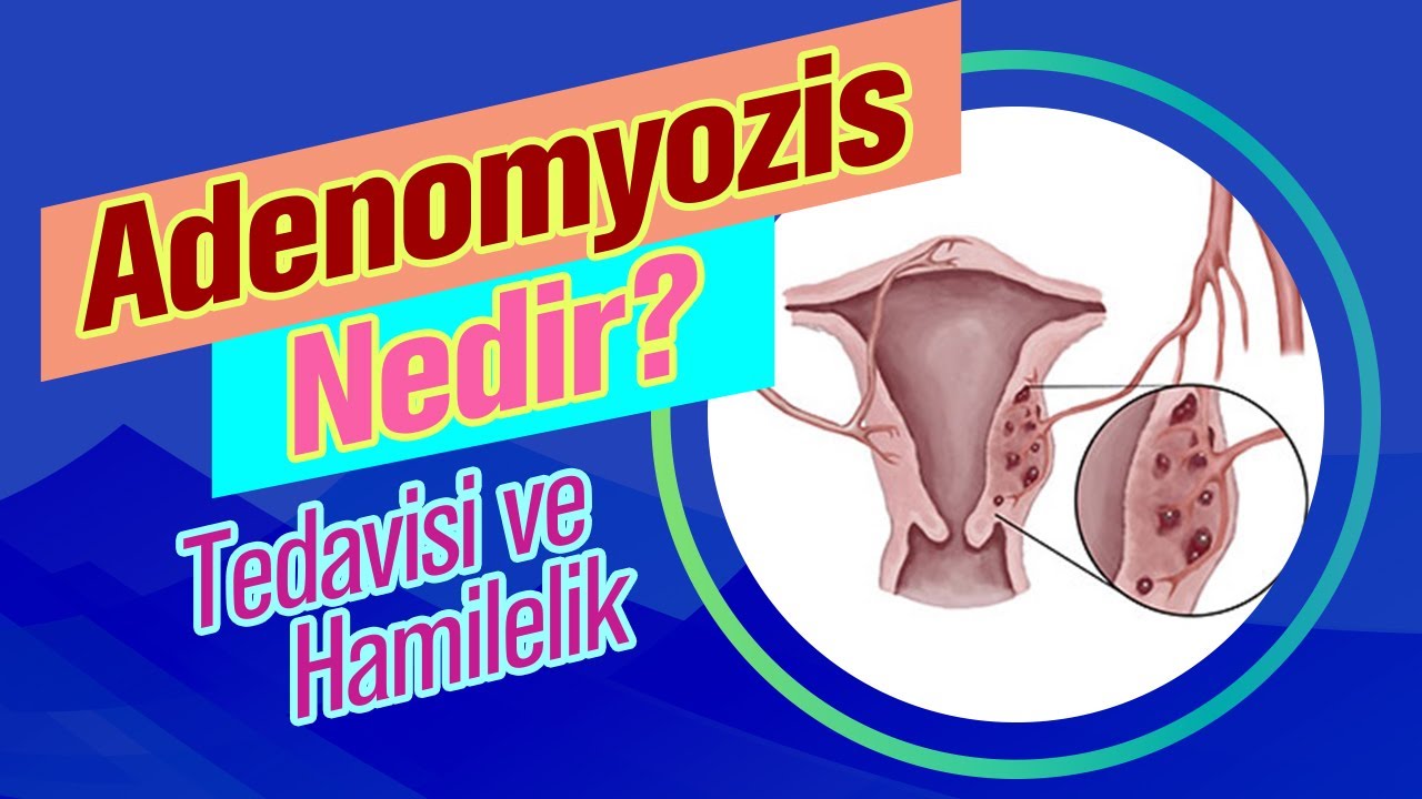 Adenomyozis Nedir? Adenomiyozis Tedavisi ve İnfertilite - Prof. Dr. Gamze Sinem
