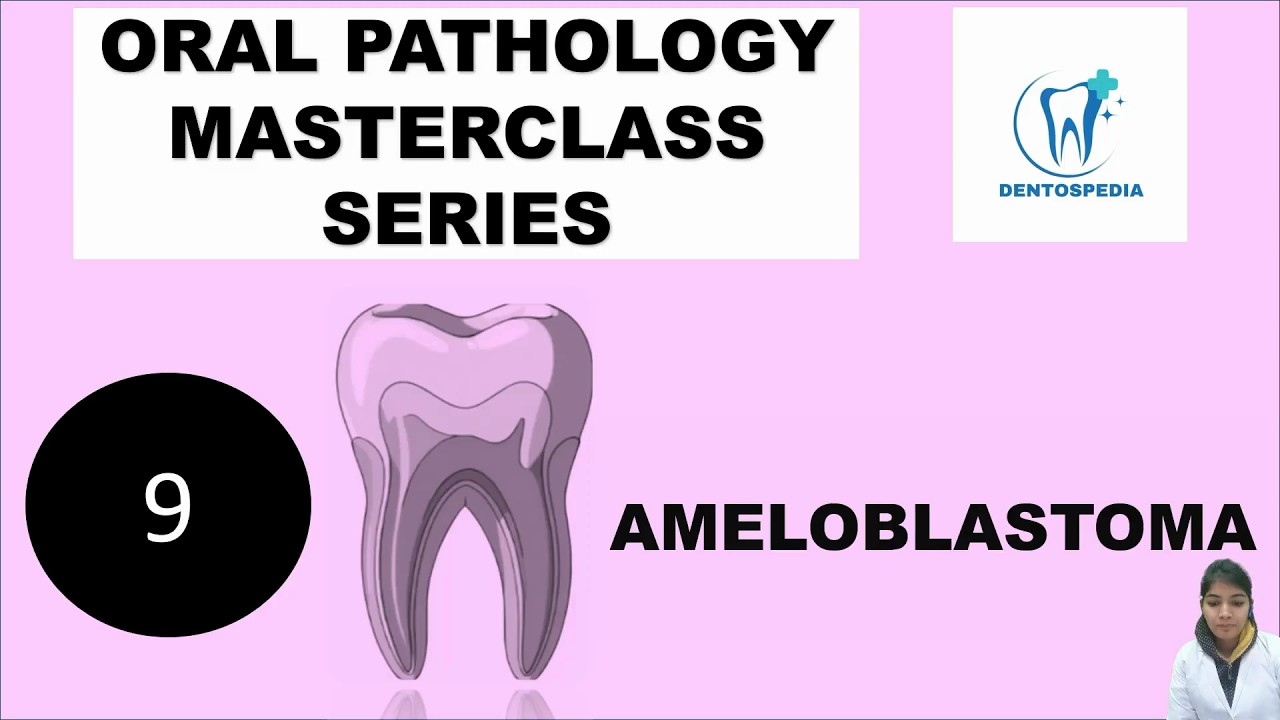 OP 9 Ameloblastoma Explained | Oral Pathology | Radiographic & Histologic Features | #AFK #ADAT #ORE