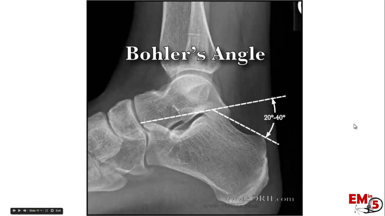 Calcaneal Fractures