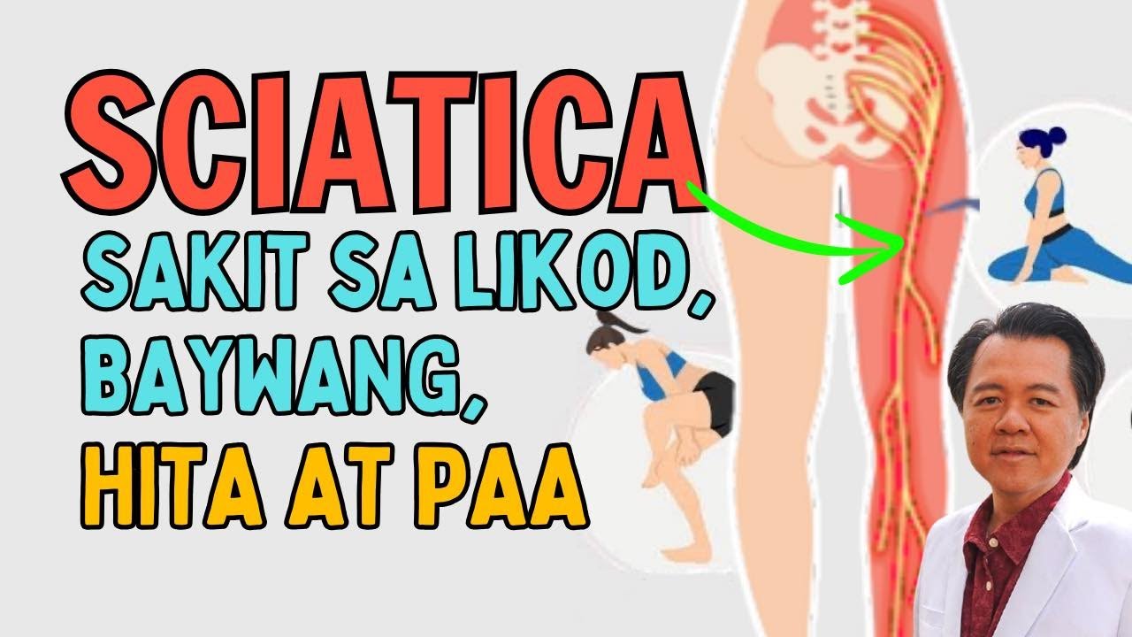 Sciatica: Sakit sa Likod, Baywang, Hita at Paa - By Doc Willie Ong at Doc Liza Ong