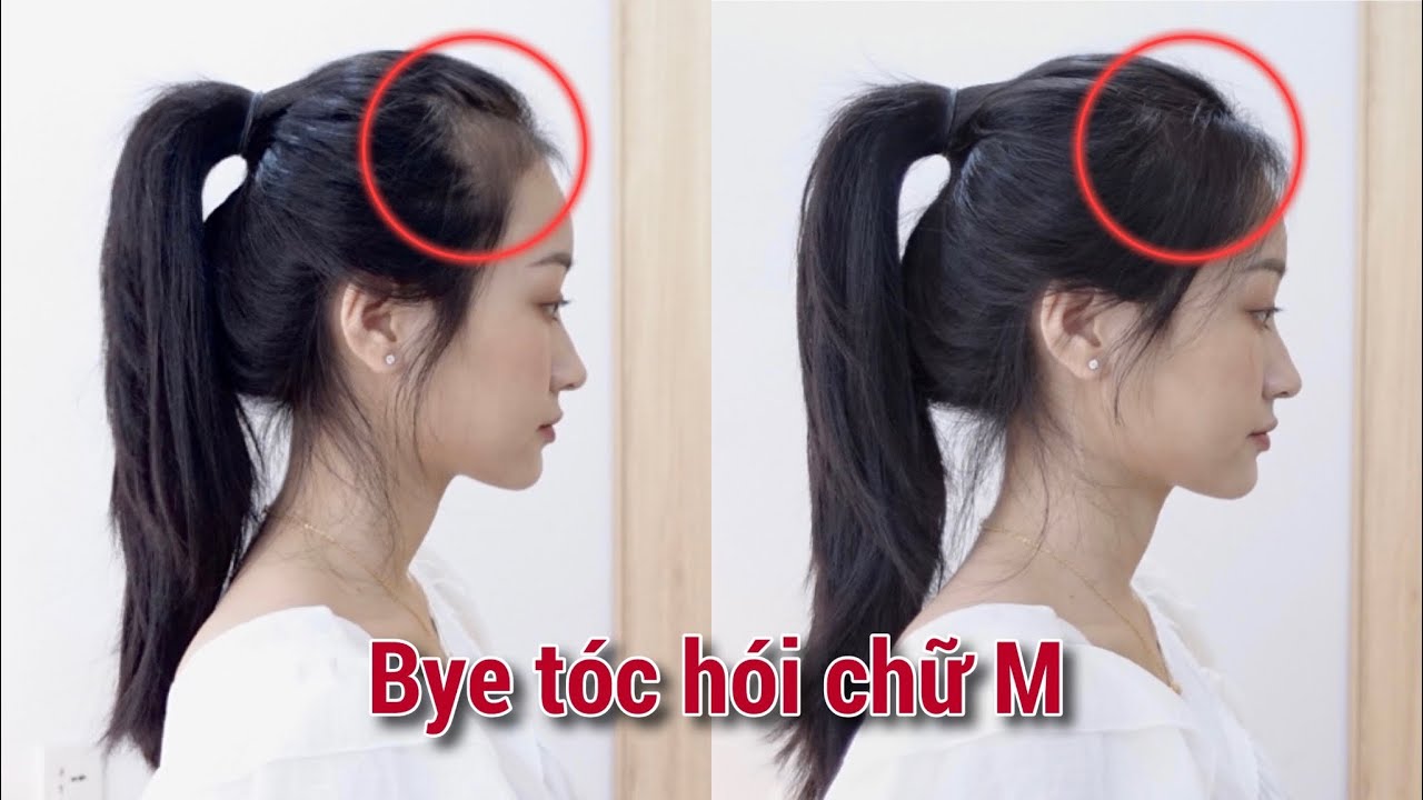 CÁCH CẮT TÓC CHE HÓI TRÁN CHỮ M HIỆU QUẢ NHẤT | TÓC BÒ LIẾM | Chỉnh sửa đường chân tóc chữ M cho nữ