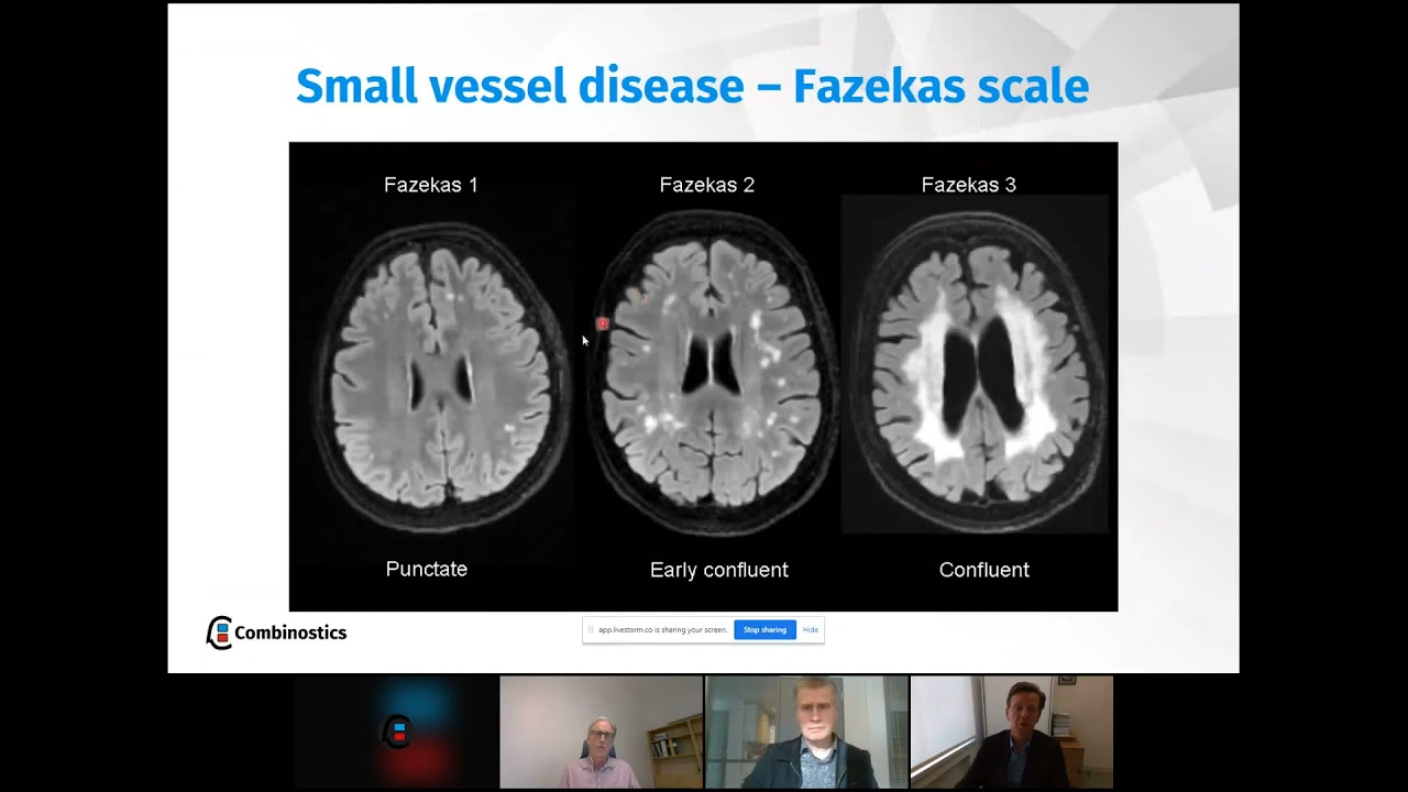 Dementia MRI interpretation - towards quantitative assessments