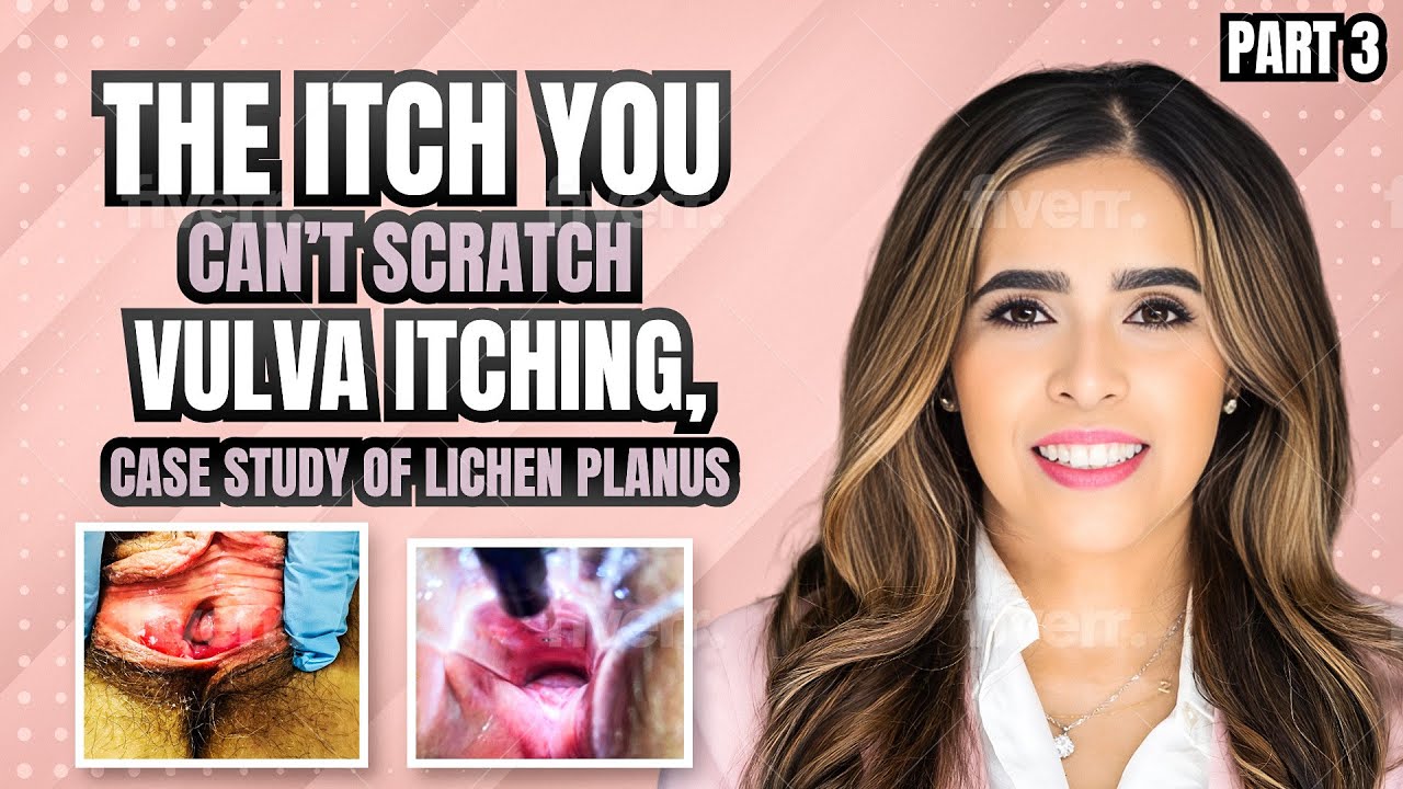 The Itch You Can't Scratch Vulvar Itching: Case Study of Lichen Planus