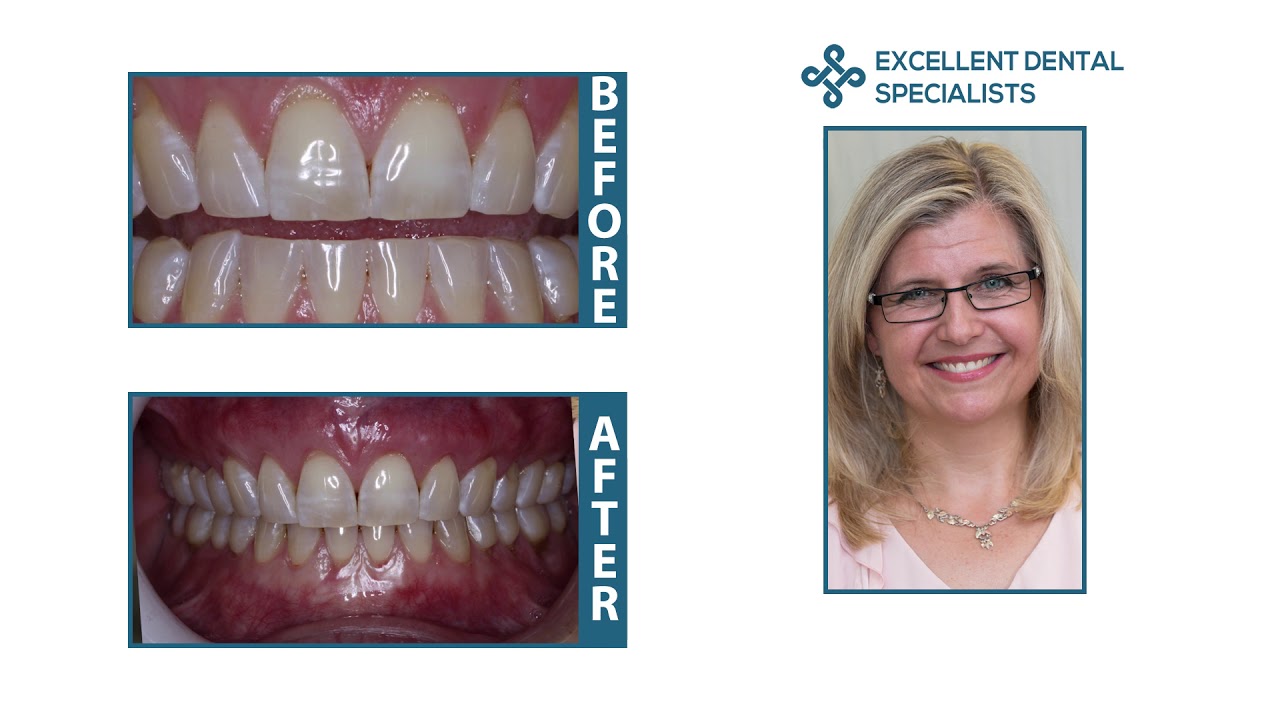 After pinhole surgery it's so nice to be able to smile in public! - Rebecca's Patient Testimonial
