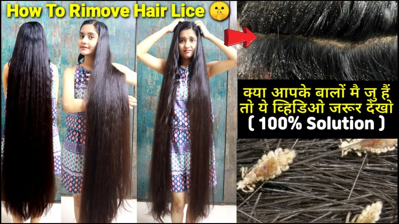 How To Remove Lice Permanently || बालों से जू कैसे निकाले हमेशा के लिये || @INDIAN GLAMOUR