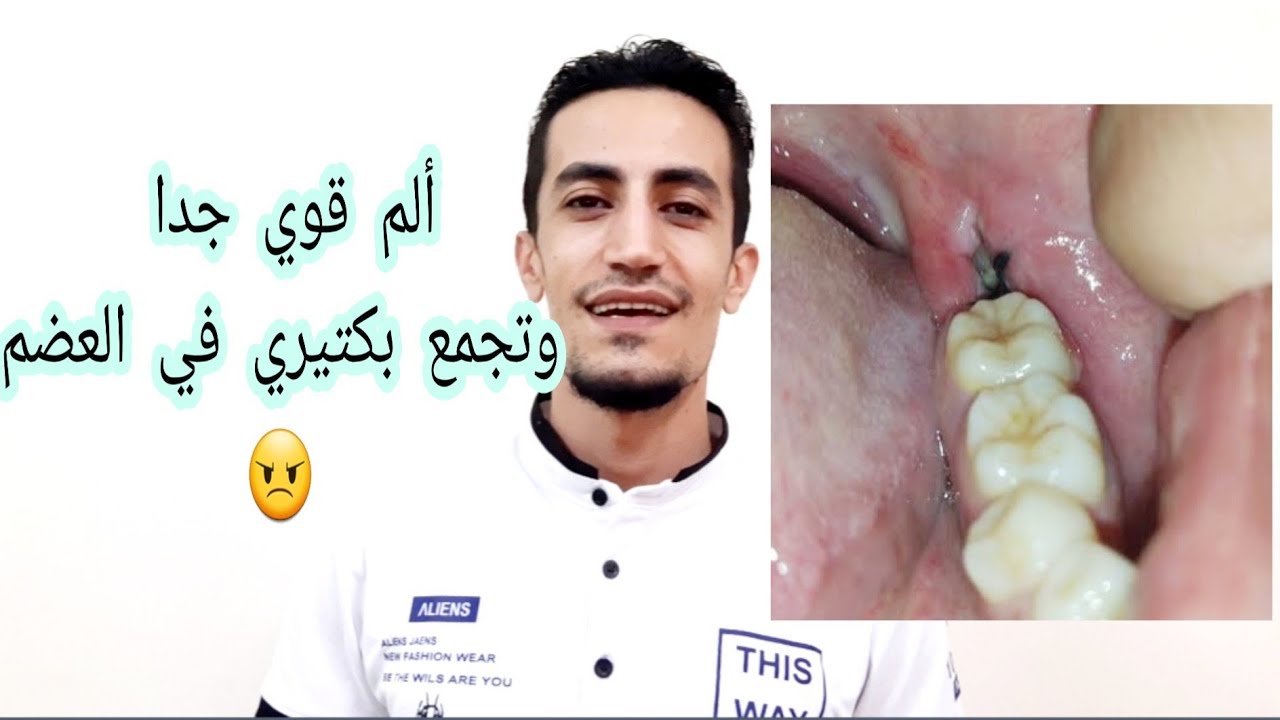 اسباب الالم والالتهاب بعد خلع ضرس العقل وأصعب أنواع الالتهاب بعد الخلع((الحل بالتفصيل))🛑👉