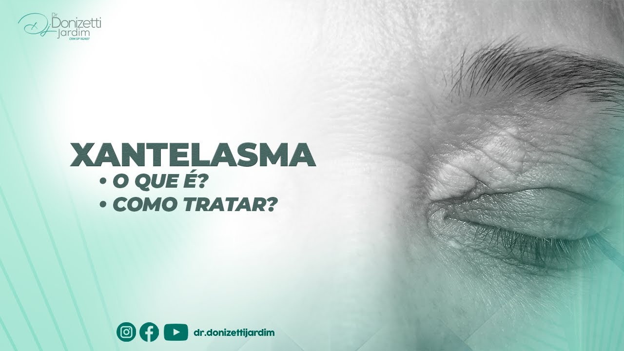XANTELASMA - O QUE É e como TRATAR? - Dr. Donizetti Jadim