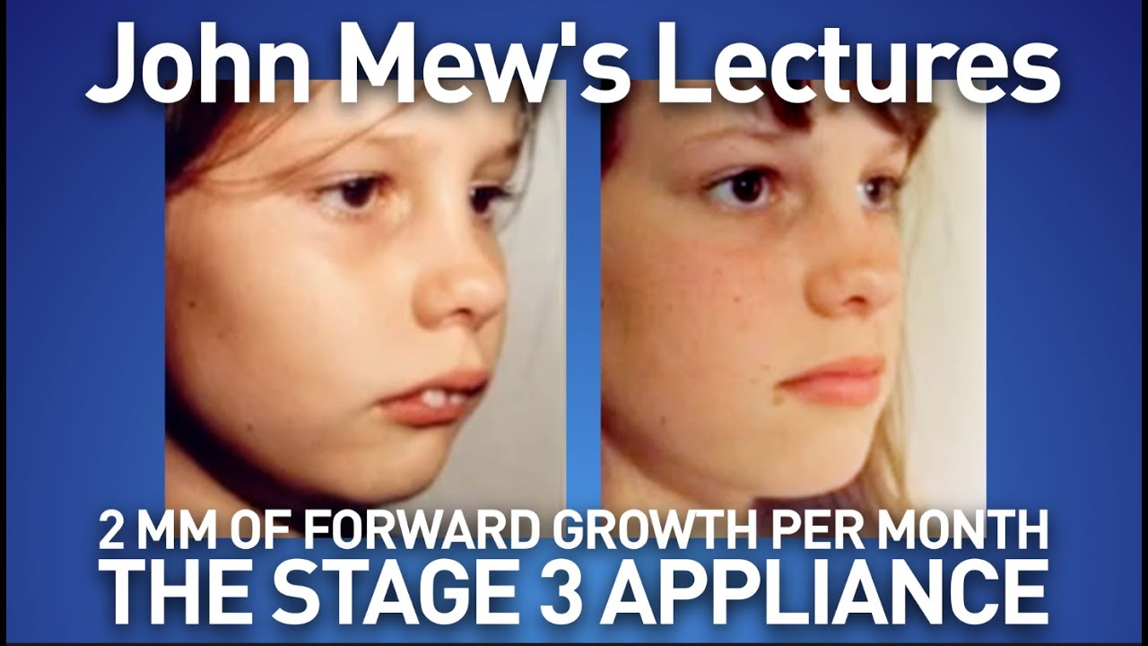 John Mew's lectures part 20: the stage 3 appliance