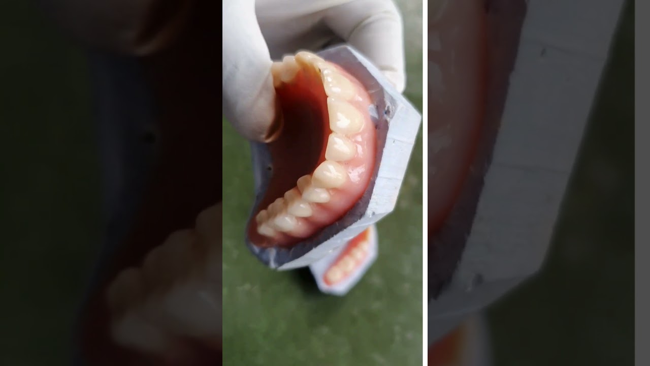 Complete Dentures | Edentulous patient #shorts