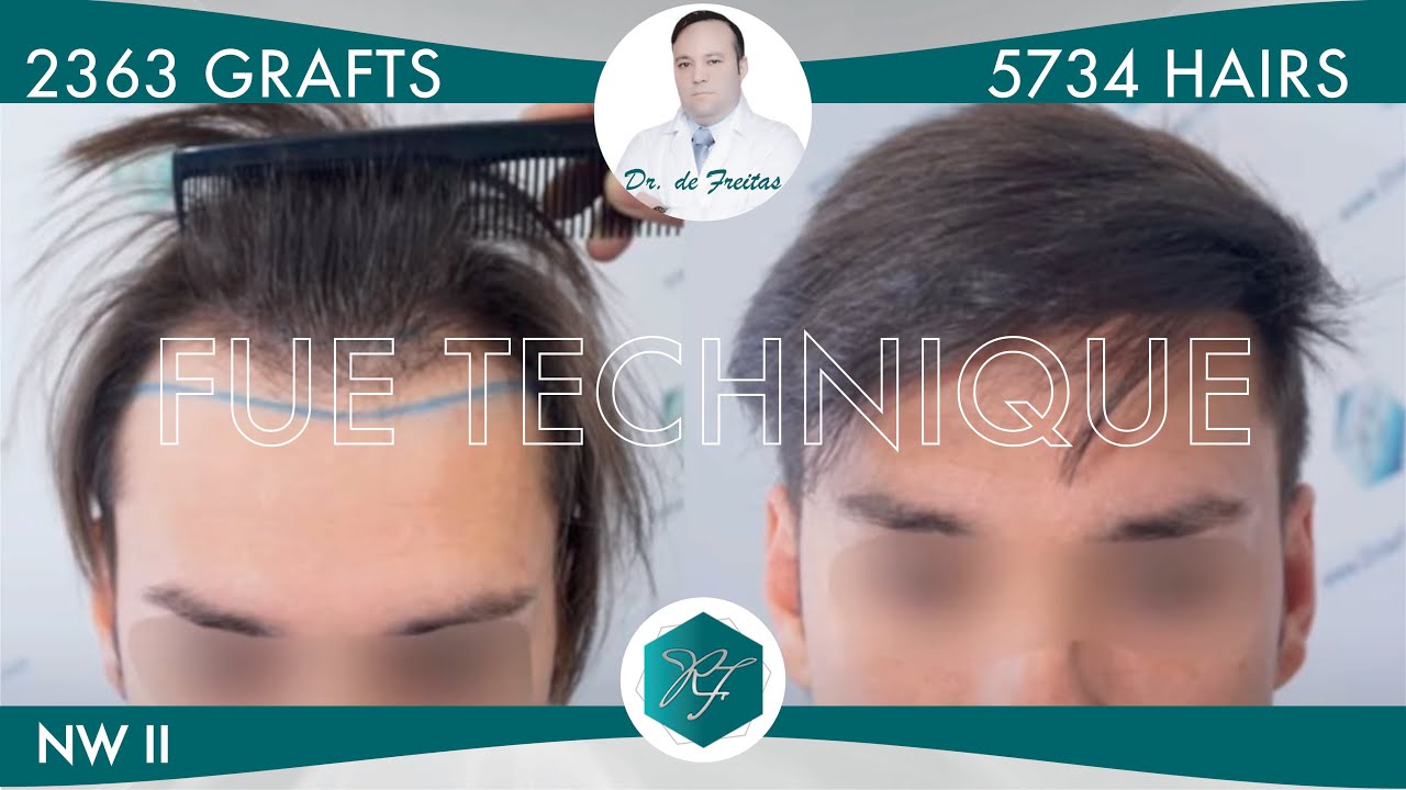 Injerto Capilar Técnica FUE – 2.363 Grafts (5.734 Pelos) – Dr. Rafael de Freitas