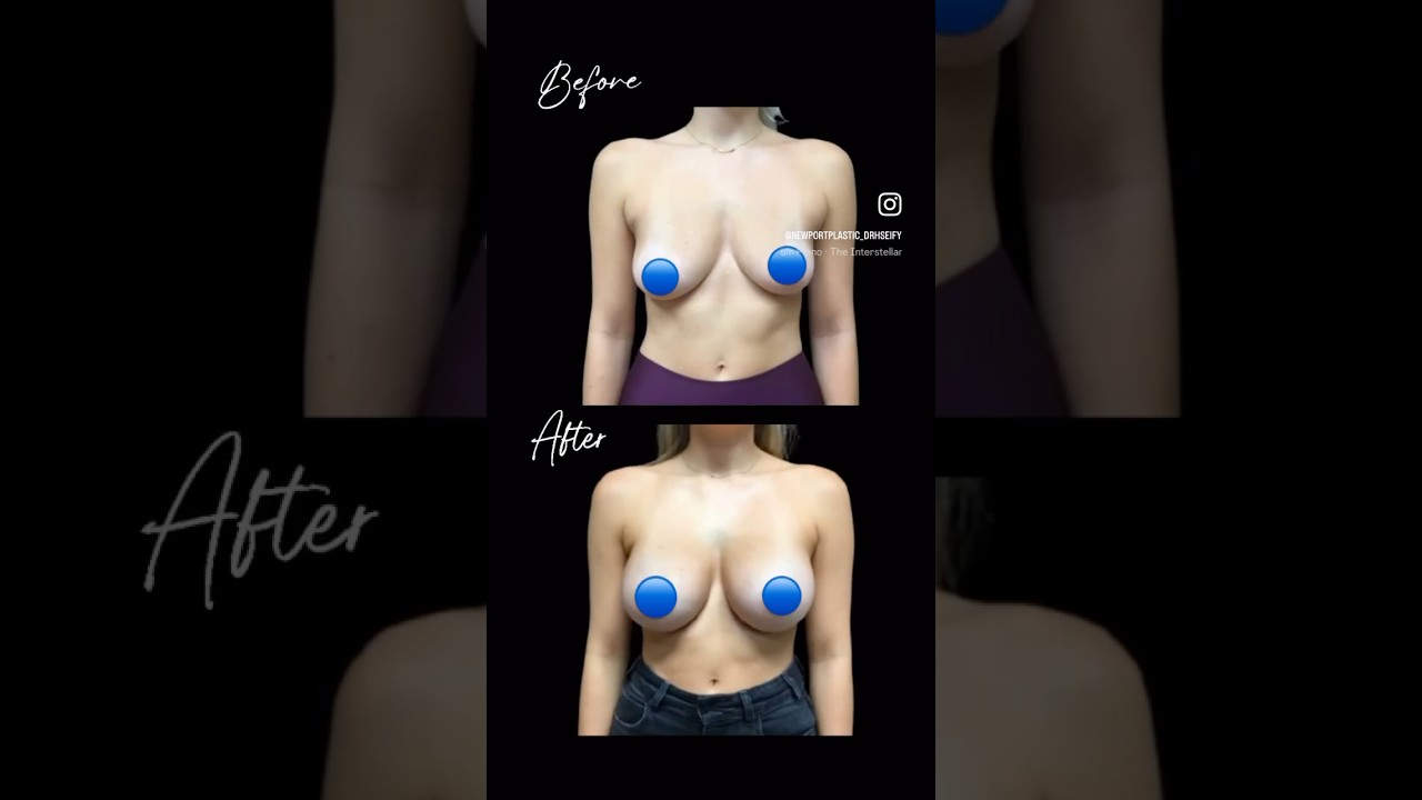 Breast Augmentation with Benelli Lift