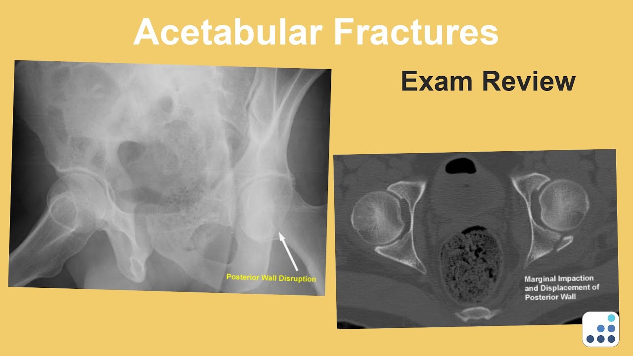 Acetabular Fractures Exam Review - Bohannon Mason, MD