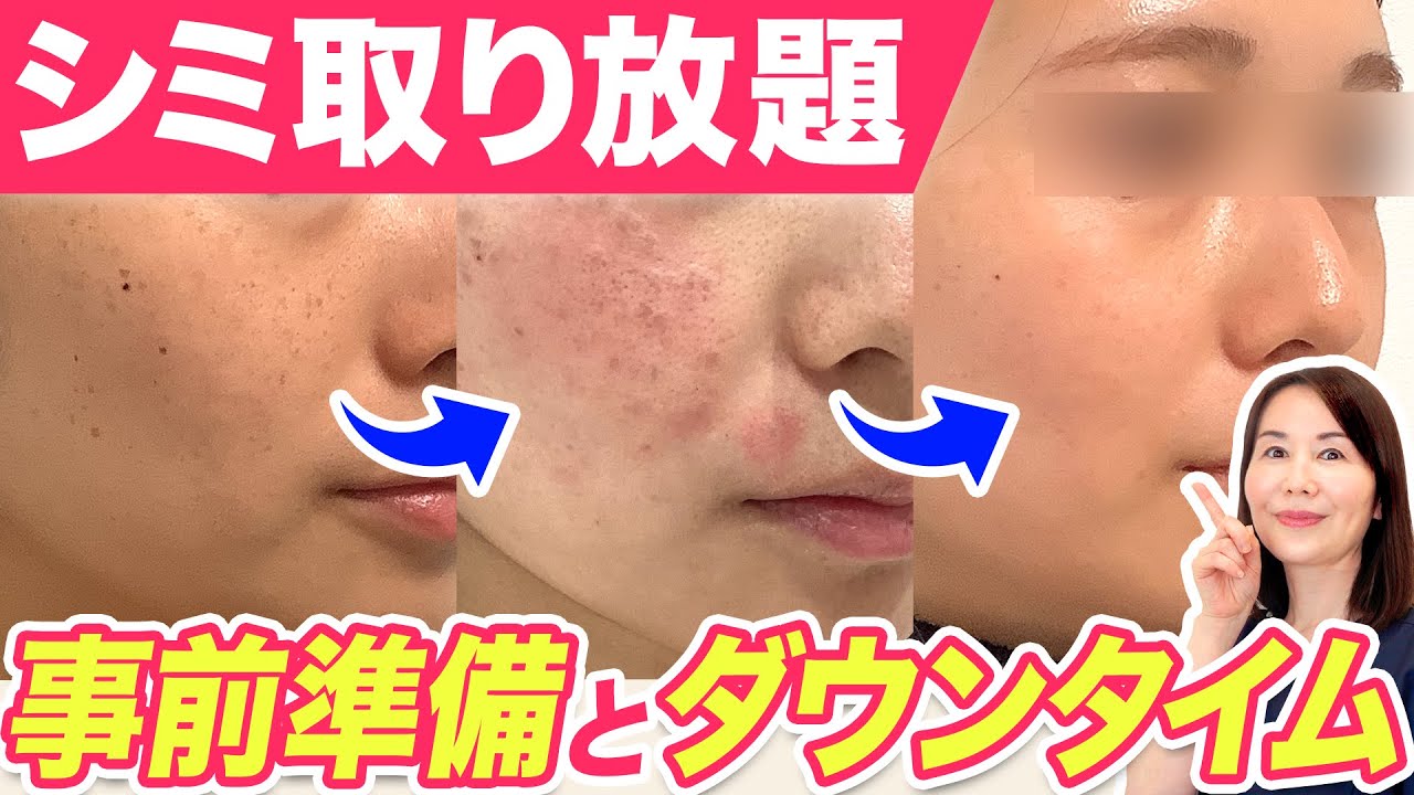 【シミ治療】徹底シミ取り！事前準備から色素沈着対策まで全部見せます♪