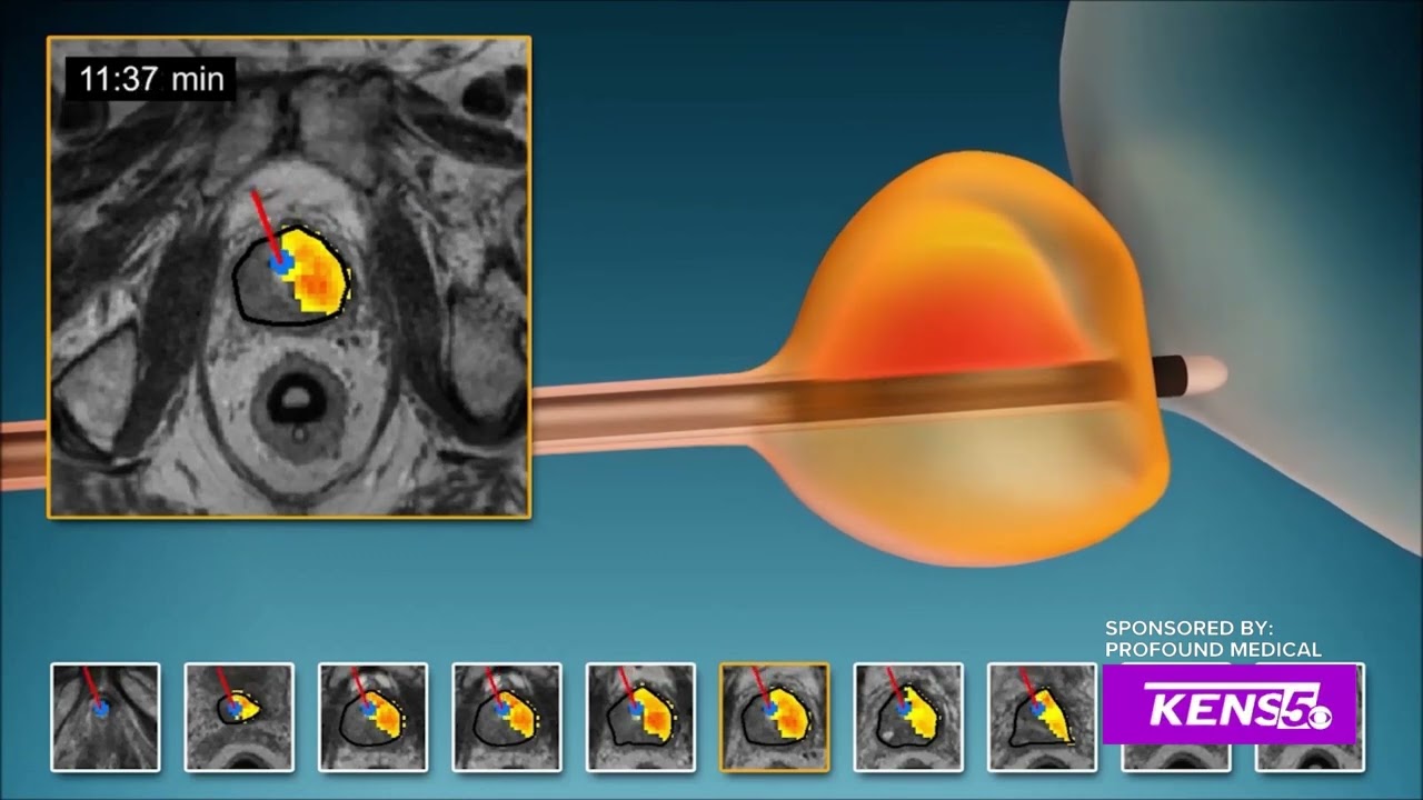 Dr Naveen Kella discusses Transurethral Ultrasound Ablation (TULSA) for Prostate Cancer and BPH