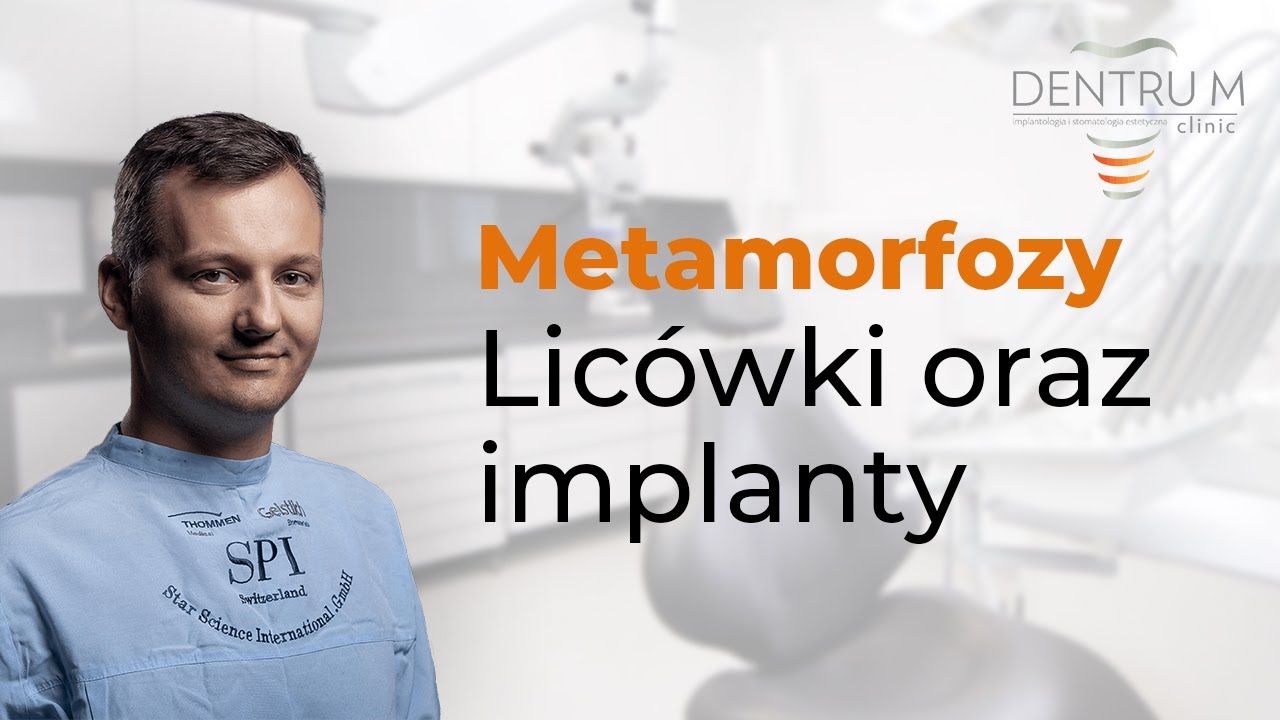 Metamorfoza licówki oraz implanty ładne zęby